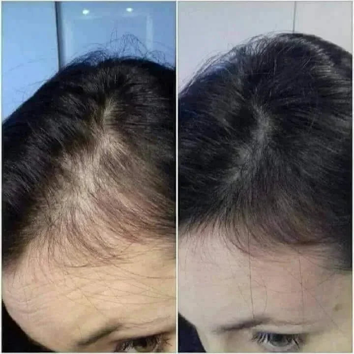 Photo avant-après montrant la repousse rapide des cheveux avec traitement kératine Cynatine HNS 500 mg